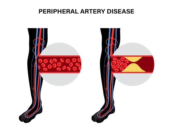 Enfermedad de las arterias periféricas