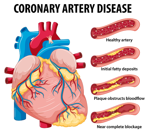 Illustration showing plaque buildup along an artery wall, narrowing the artery and restricting blood flow.