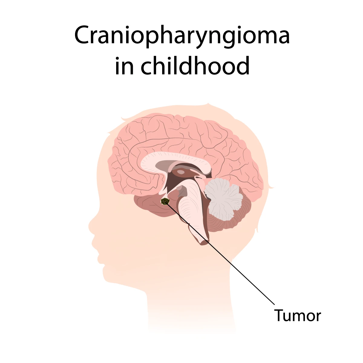 Craniopharyngioma