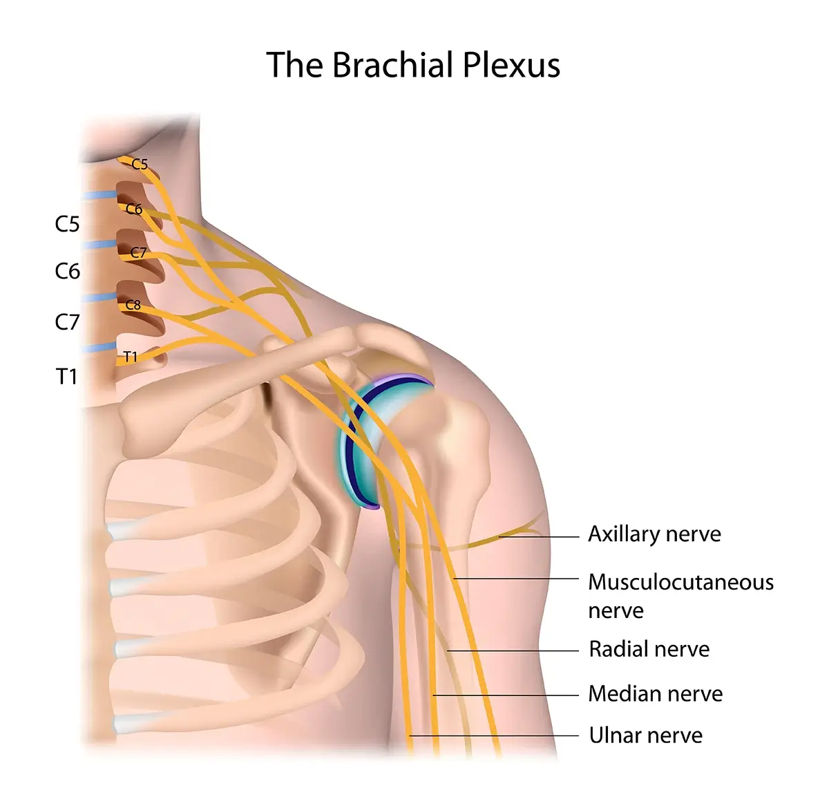 Parsonage Turner Syndrome
