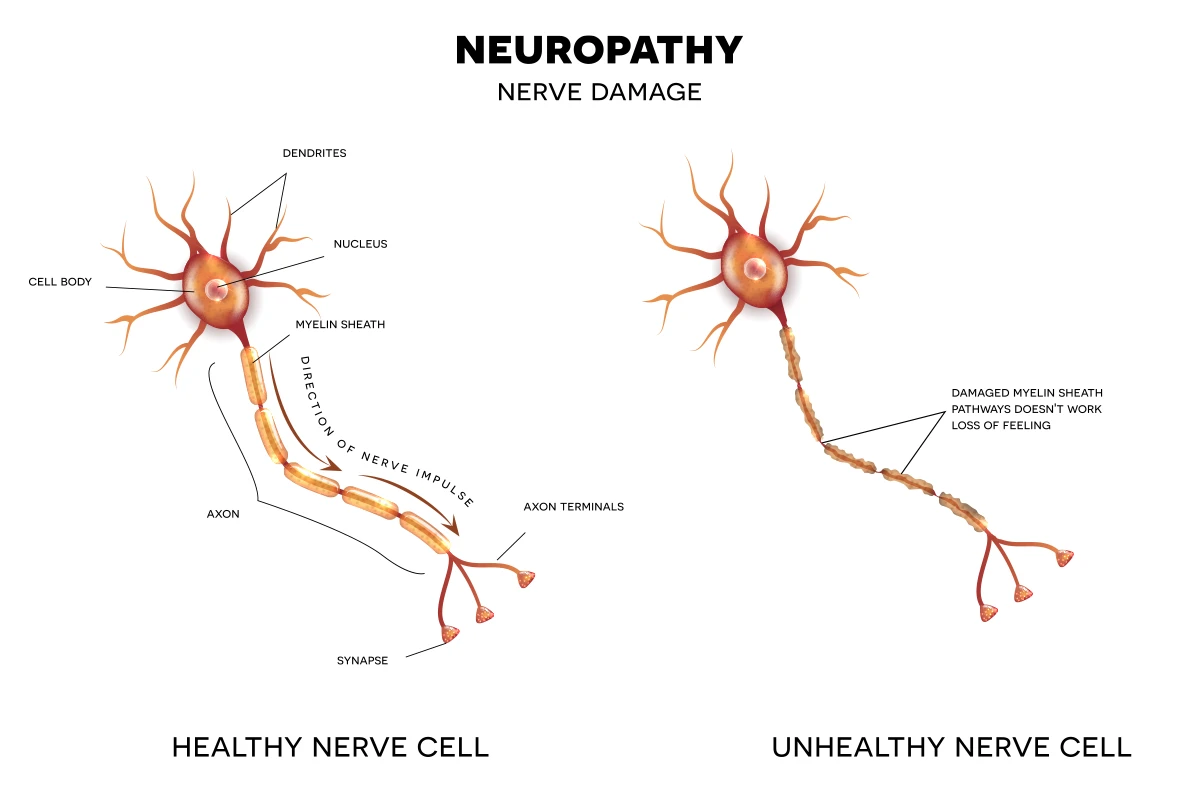 Peripheral Neuropathy