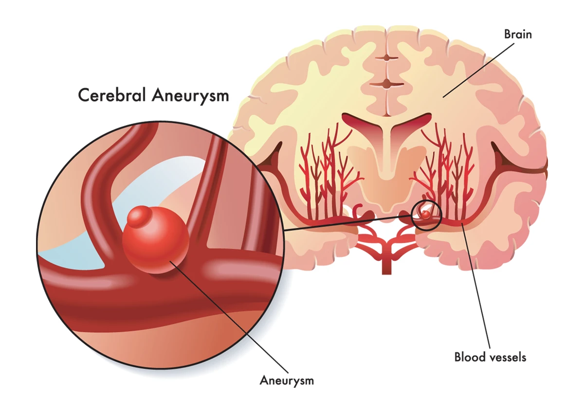 Un aneurisma cerebral es un vaso sanguíneo abultado, como se muestra en la imagen de arriba.