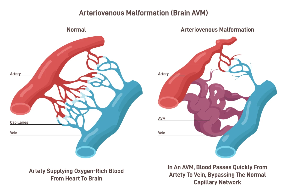La imagen muestra una conexión normal entre una arteria y una vena en comparación con una malformación arteriovenosa. 