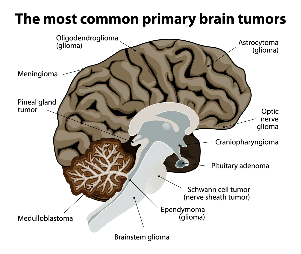 This image shows the most common primary brain tumors and their likely locations.
