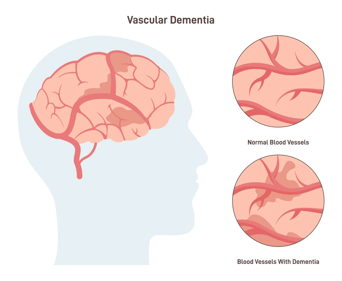La imagen muestra la diferencia entre los vasos sanguíneos normales del cerebro y los vasos sanguíneos alterados por la demencia vascular, un tipo común de demencia. La demencia vascular provoca sangrados microscópicos en el cerebro.
