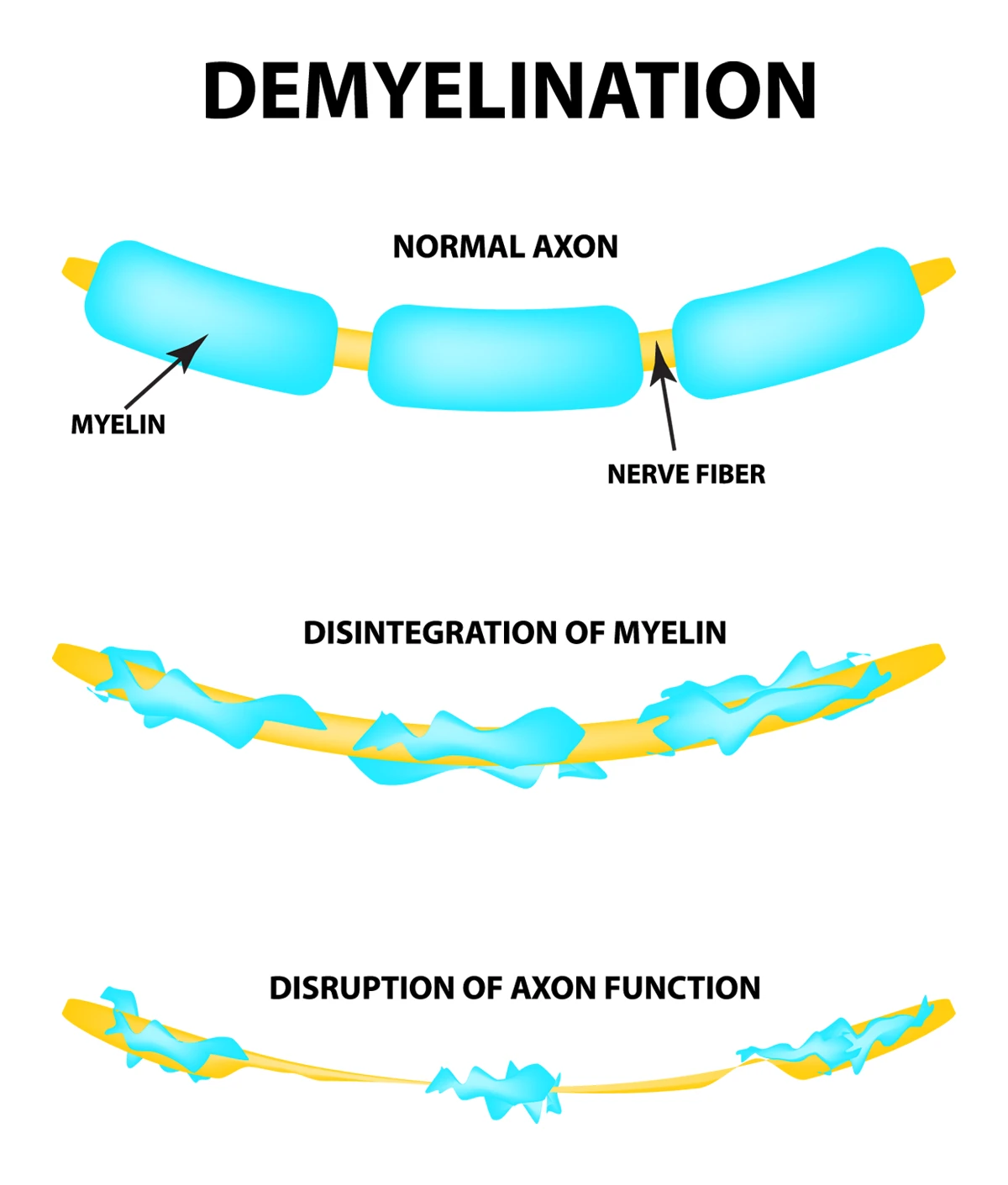 Image shows the process of demyelination, the loss of myelin and abnormal axon function due to a type of demyelinating disease.