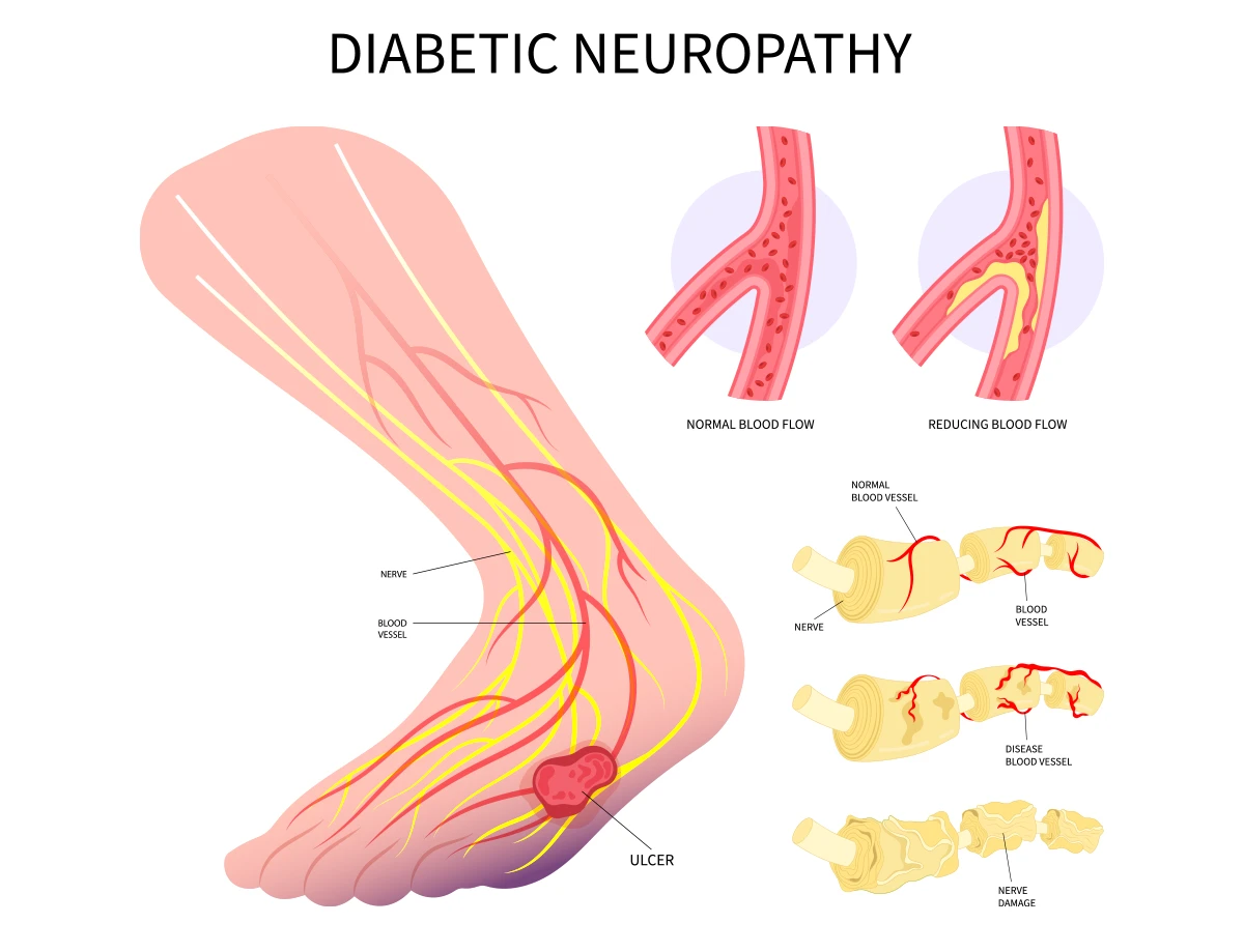 La neuropatía diabética puede causar úlceras, interrumpir la circulación y dañar los nervios del pie.