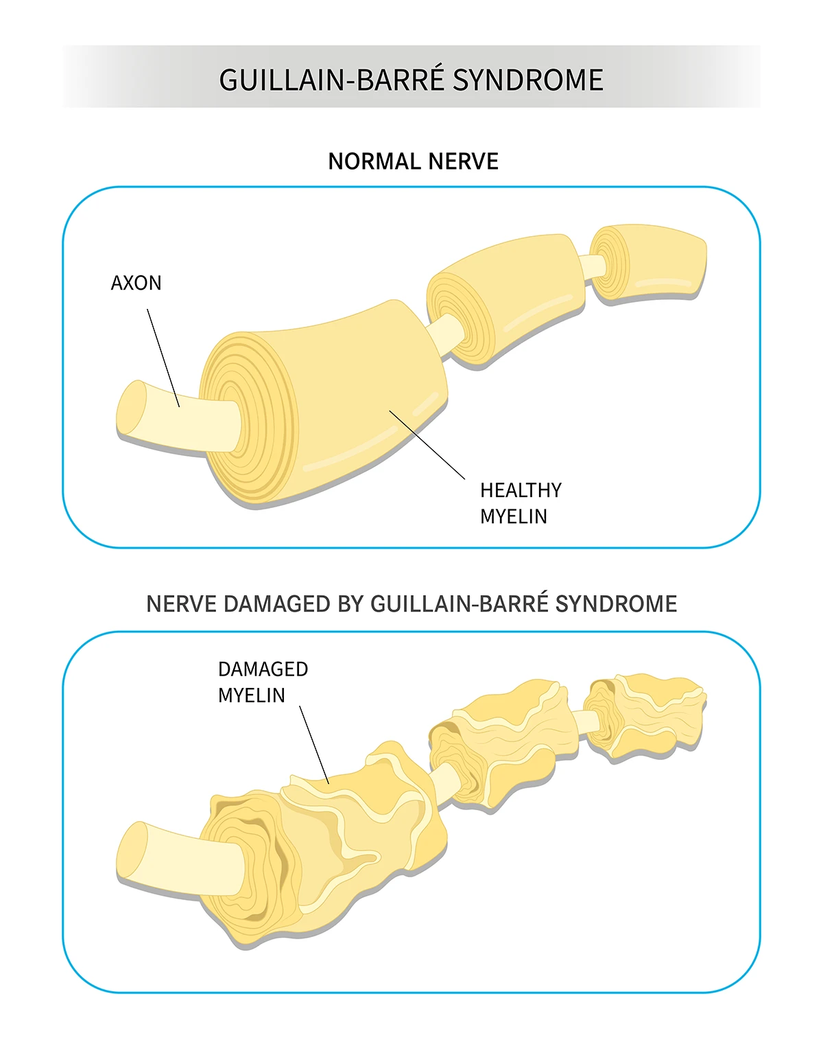 Guillain Barre syndrome