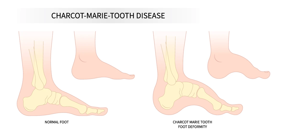 Charcot-Marie-Tooth disease causes a deformity of the foot as illustrated above.