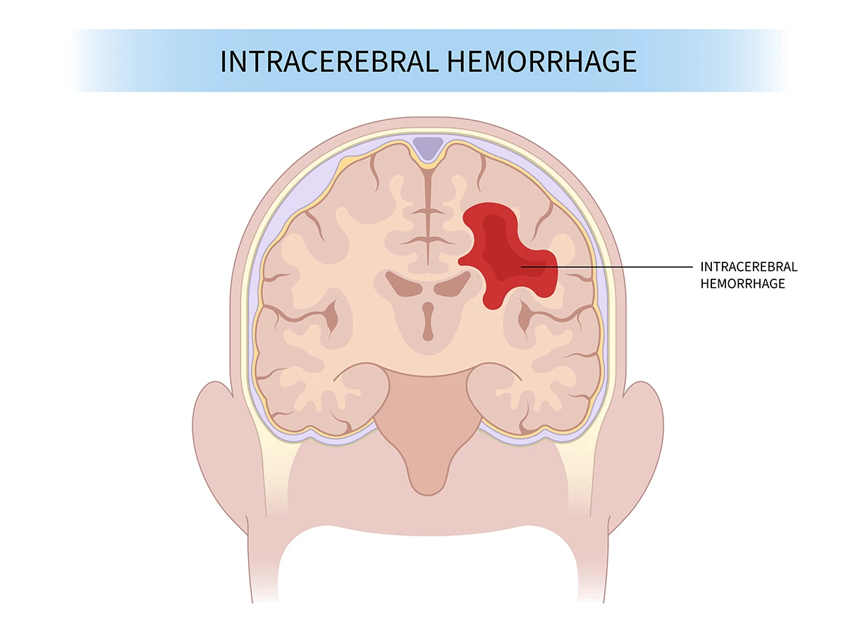 Intracerebral Hemorrhage Advocate Health Care Intracerebral Hemorrhage Advocate Health Care
