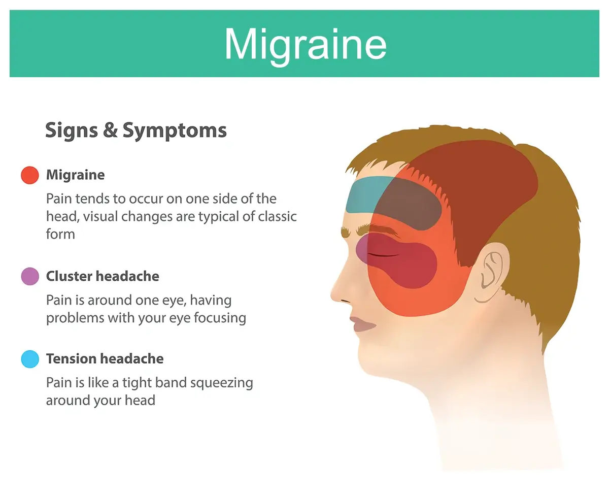 migraine