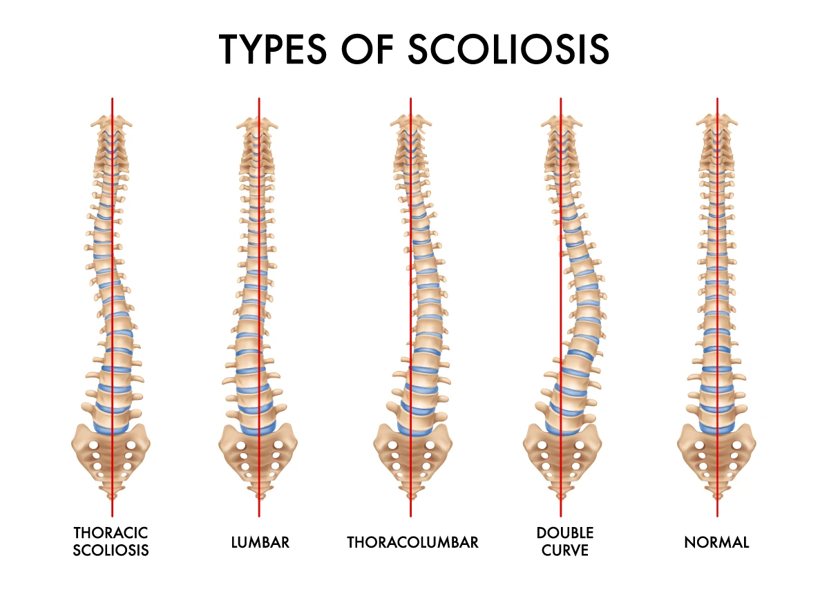 Types of scoliosis