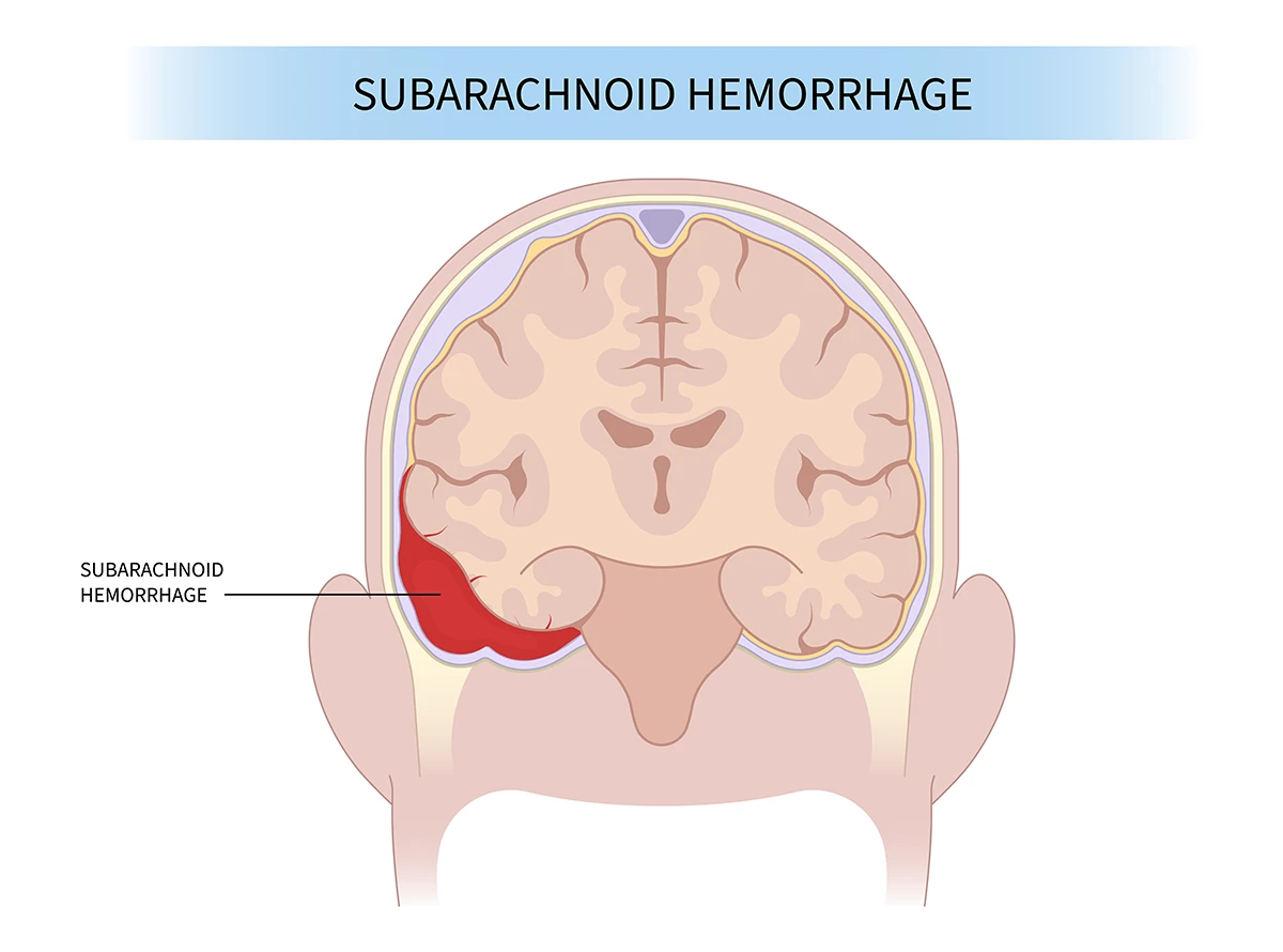 subarachnoid