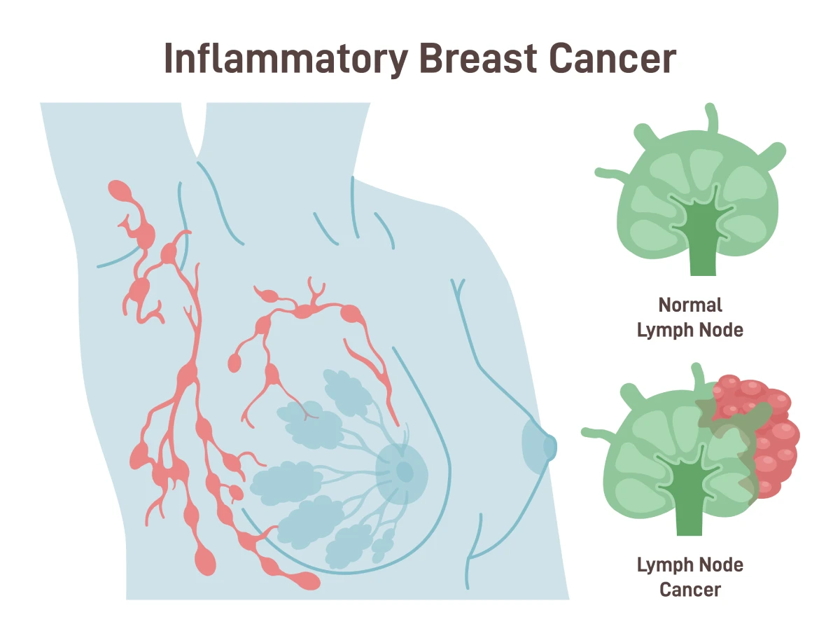 The image shows a lymph node infected with inflammatory breast cancer compared to a healthy lymph node.