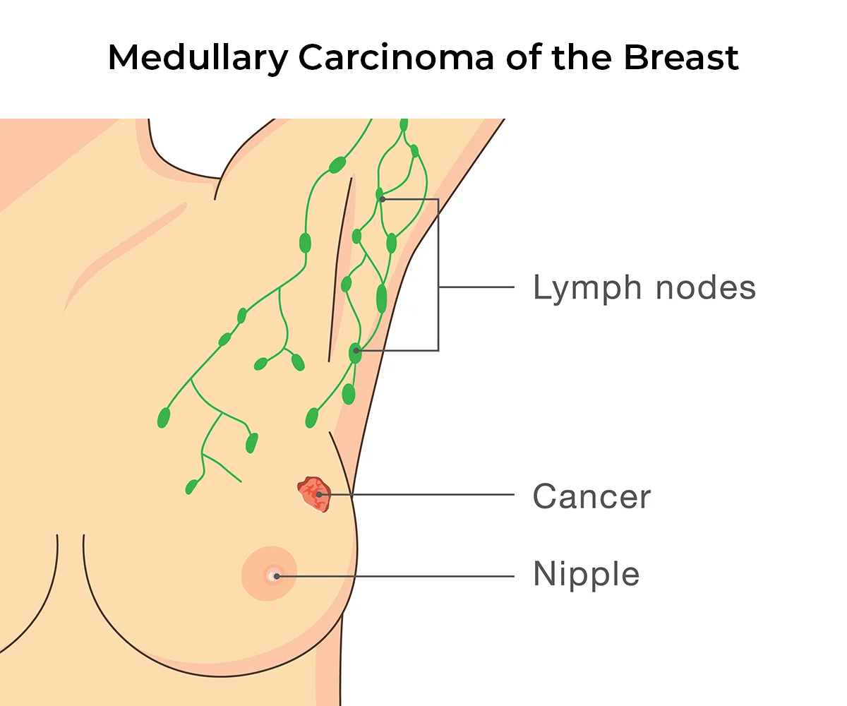 The image shows a defined cancer cell on the breast isolated to one area.