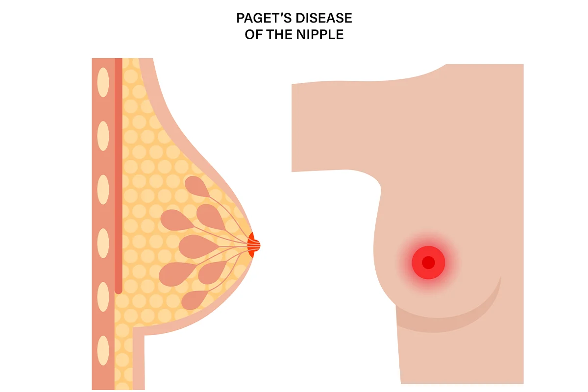 Diagram depicting Pagets disease of the nipple.