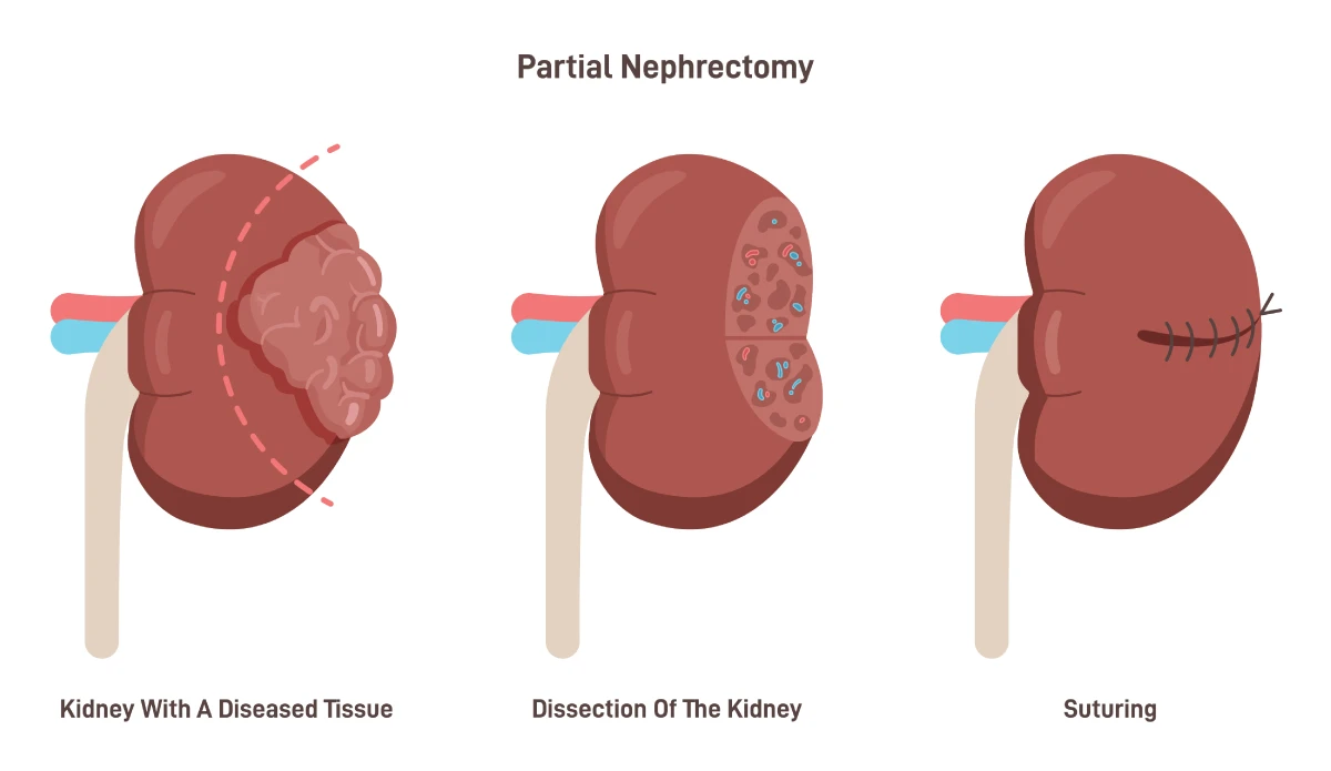 Diagram depicting partial nephrectomy of kidney.