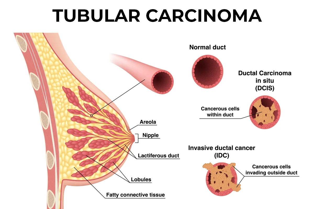 Diagram depicting tubular carcinoma. 