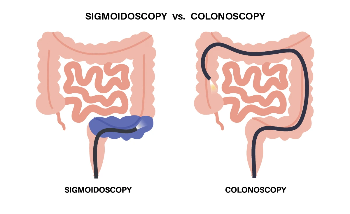 Sigmoidoscopy vs colonoscopy
