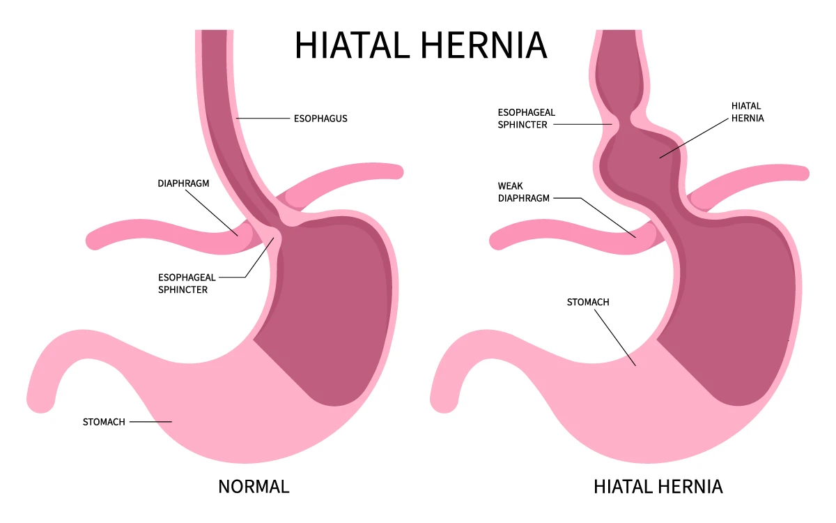 Hiatal hernia image