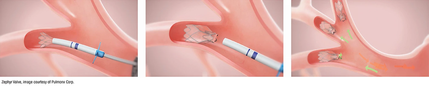 lung valves procedure