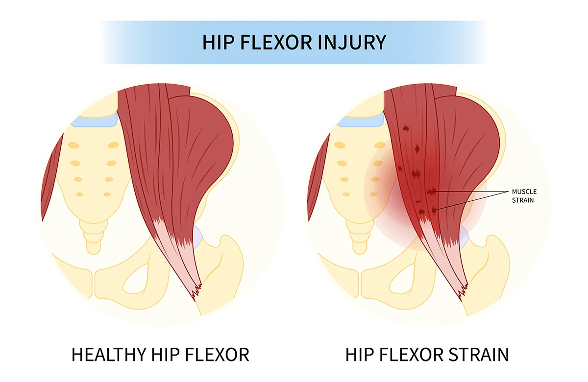 The image shows the difference between a healthy hip flexor and a hip flexor injury.