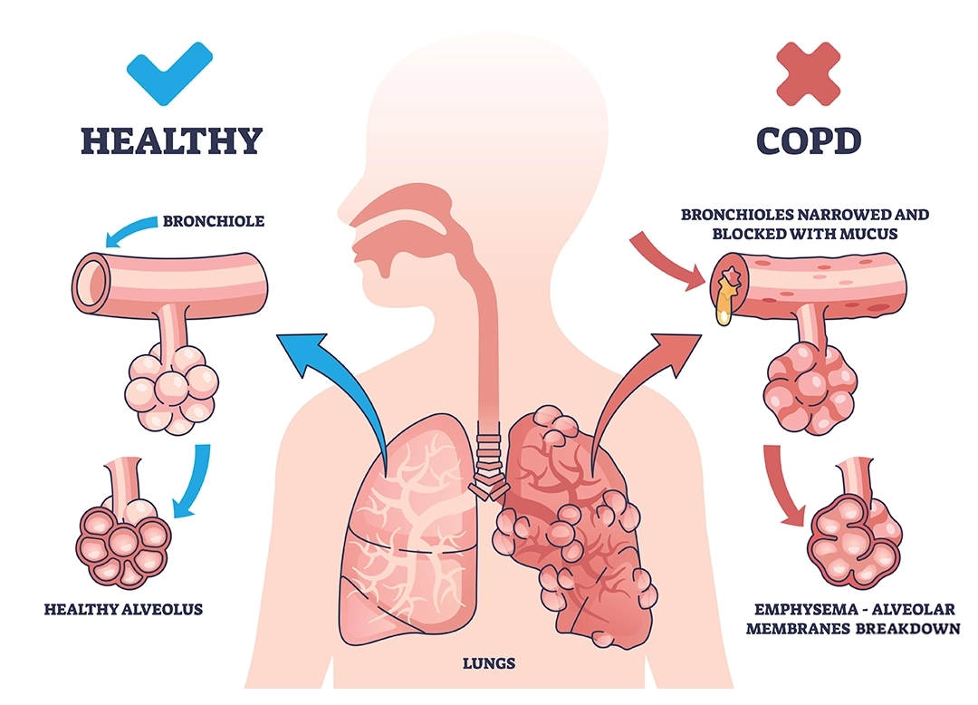 Ilustración de un pulmón sano y un pulmón afectado por bronquitis crónica
