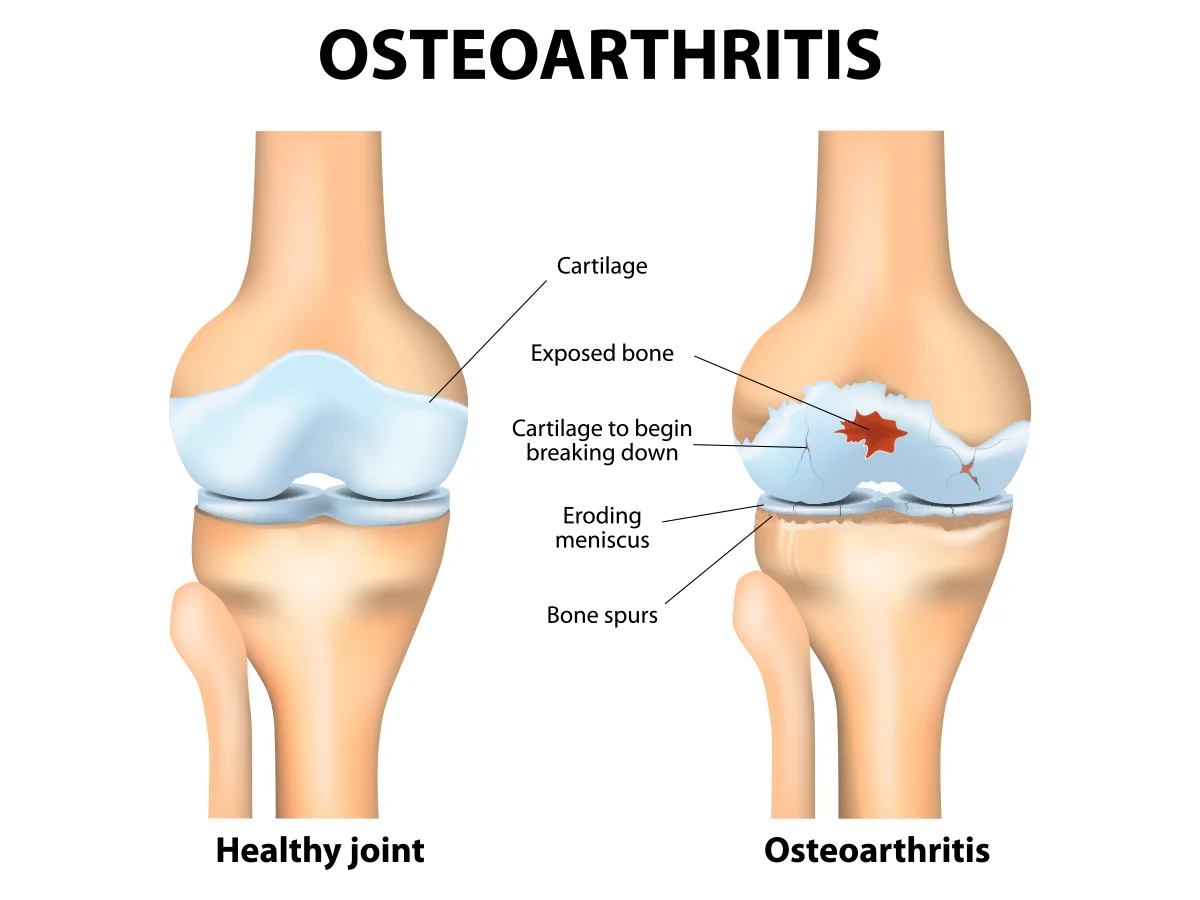 The image shows the difference between a healthy knee joint and one affected by osteoarthritis.