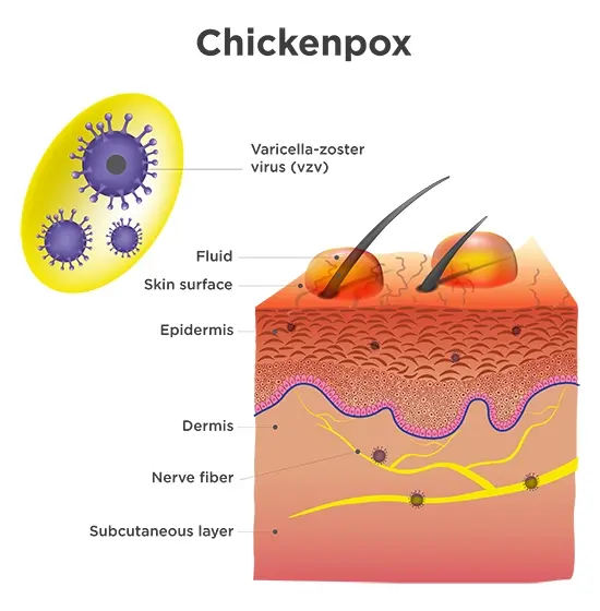 Image shows an anatomical breakdown of chickenpox