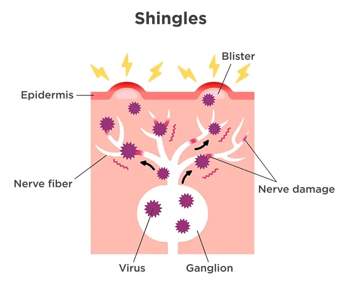 Image shows an anatomical breakdown of shingles.