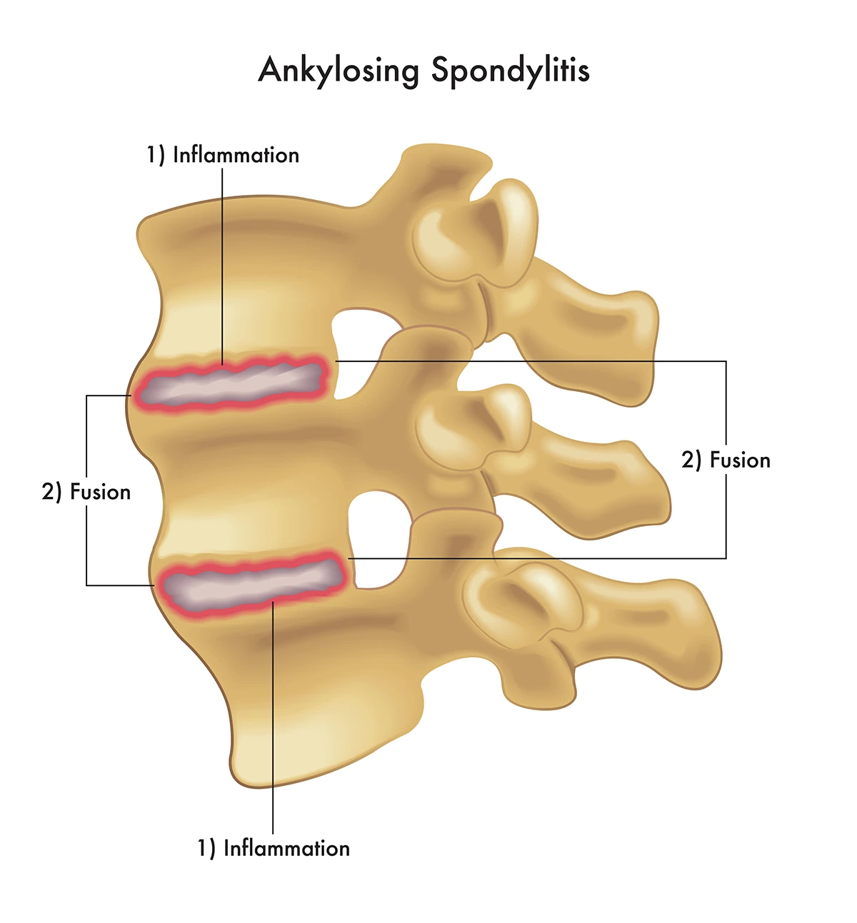 A diagram illustrates ankylosing spondylitis, where inflammation occurs between vertebrae, leading to the vertebrae becoming fused together.