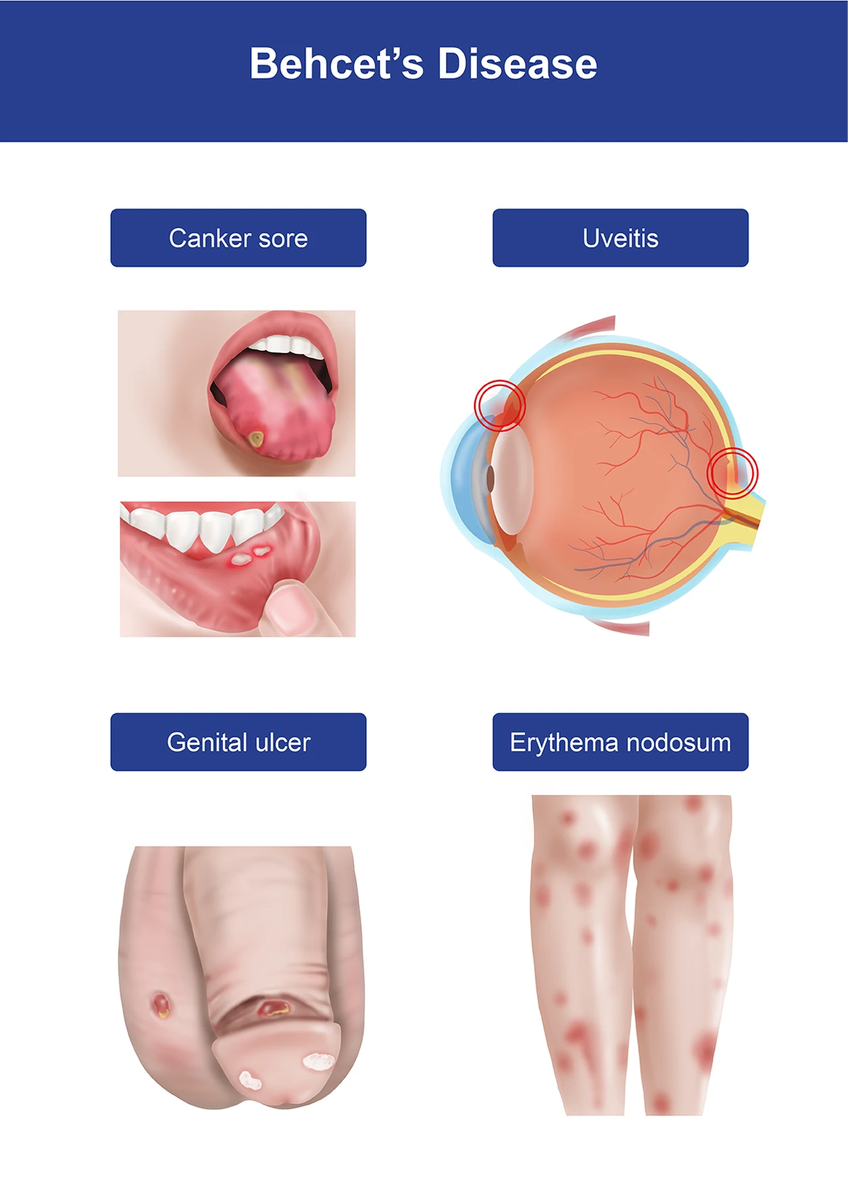 Image shows some symptoms of Behcet’s disease including mouth sores, eye inflammation, genital ulcers, and reddish, painful lumps on the legs.