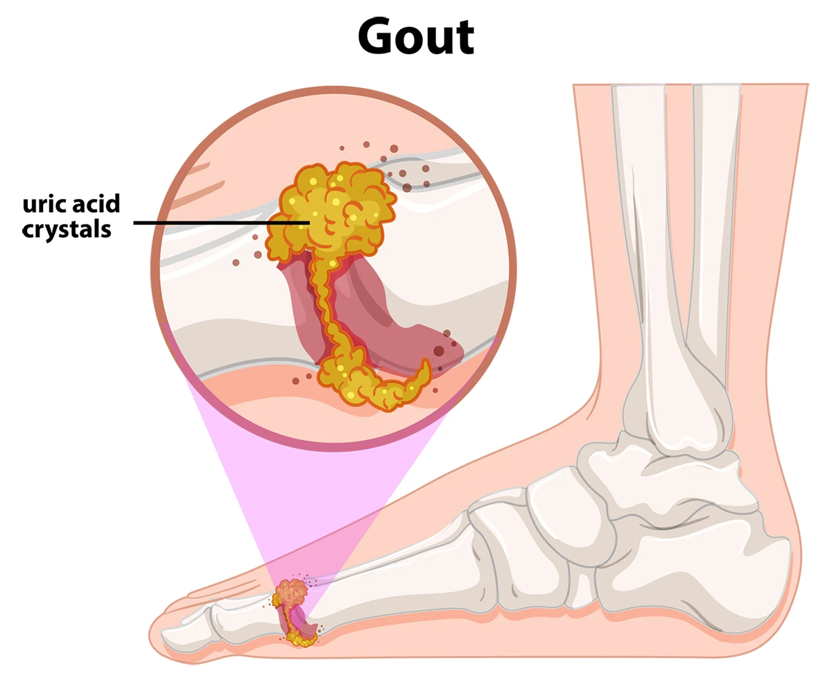 The graphic illustrates a foot with uric acid crystals forming in the joint of the big toe. This is a primary cause of gout.