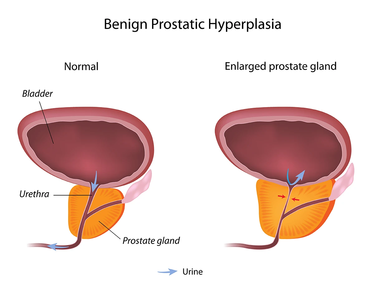 Benign prostatic hyperplasia (BPH) is a noncancerous enlargement of the prostate gland in men, as seen on the right.