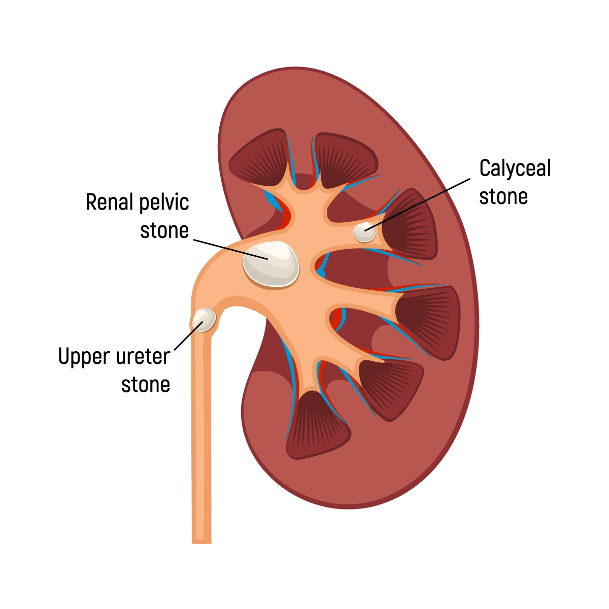 Ureteral stones Ureteral stones