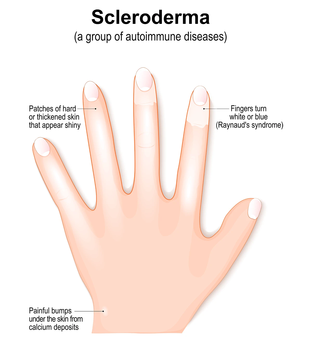 The diagram shows a hand and illustrates common symptoms of scleroderma, including patches of hard or thickened skin, painful bumps under the skin from calcium deposits and fingers turning white or blue due to Raynaud's syndrome.