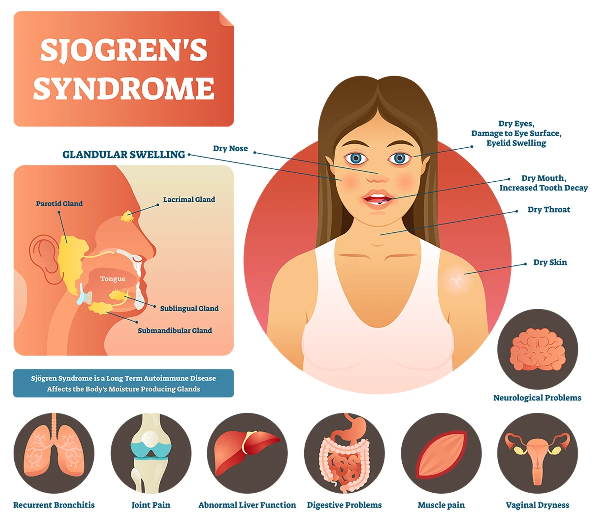 The image shows a detailed illustration of Sjogren's syndrome, highlighting swelling in the moisture-producing glands and other symptoms such as dry eyes, dry mouth, dry throat, dry skin and various complications.